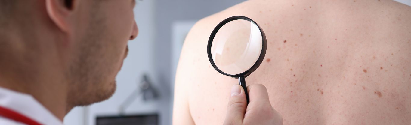 Giornata europea per la prevenzione del melanoma