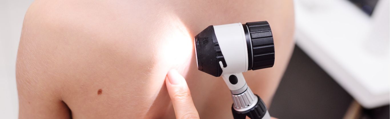 Giornata europea dedicata alla prevenzione del melanoma e dei tumori della pelle