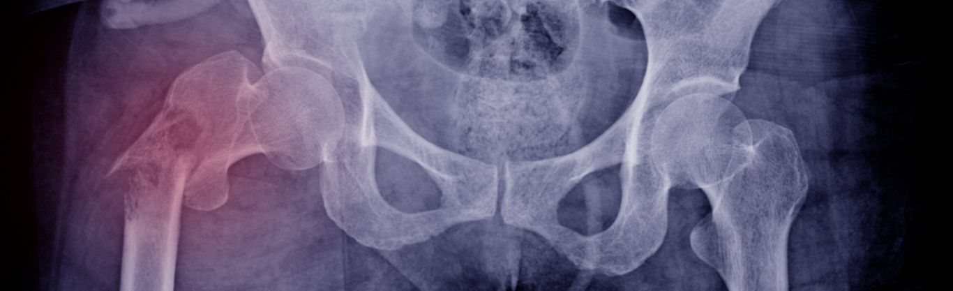 Le patologie del metabolismo osseo: osteoporosi, osteomalacia e iperparatiroidismo